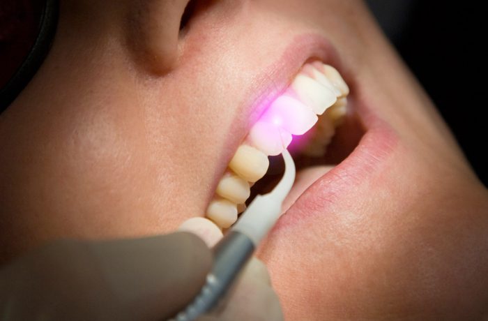 Laser_gum_001-700×460