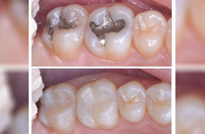 Mercury-Free-White-Fillings-in-Rancho-Cucamonga