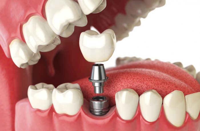 implant_001-700×460